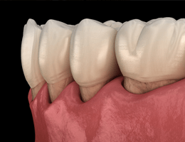 A digital image of receding gums affected by periodontal disease