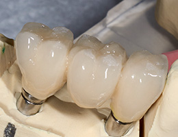 Closeup of a lower set of implant dentures in Castle Rock