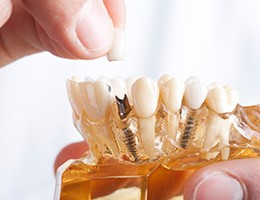 Closeup of a dentist holding a model jaw with dental implant