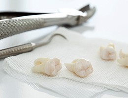 Tooth extraction in Castle Rock