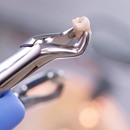 A dentist holding a pair of dental forceps after extracting a wisdom tooth