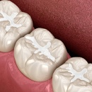 Digital image of three tooth-colored fillings on the bottom arch