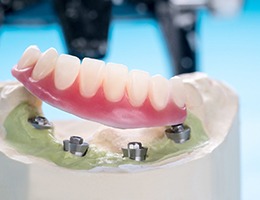 An up-close image of a lower set of overdentures be affixed to dental implants sitting within a dental mold