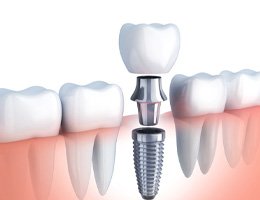 A digital illustration of a single tooth dental implant in Castle Rock 