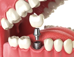 A digital image of a dental implant and the metal abutment securing the restoration to the implant on the lower arch of the mouth