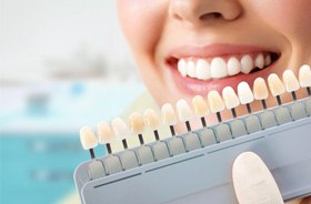 Dentist using a shade guide in Castle Rock 