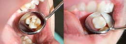 A before and after image of a person’s decayed tooth and the metal-free filling used to repair it in Castle Rock