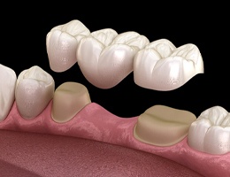 A digital image of a metal-free dental bridge being placed on the lower arch of the mouth in Castle Rock