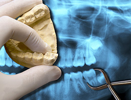 Model of smile and x-rays of wisdom teeth