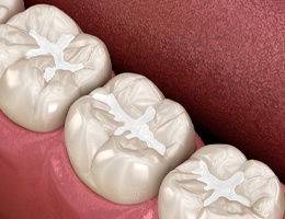 Tooth-colored fillings in Castle Rock