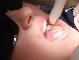 Dental patient receiving tooth-colored filling in Castle Rock