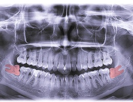 Digital X-ray of wisdom teeth in Castle Rock