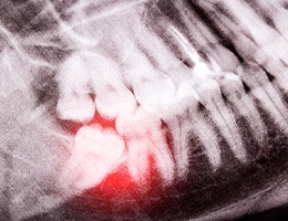 A partially erupted wisdom tooth in Castle Rock