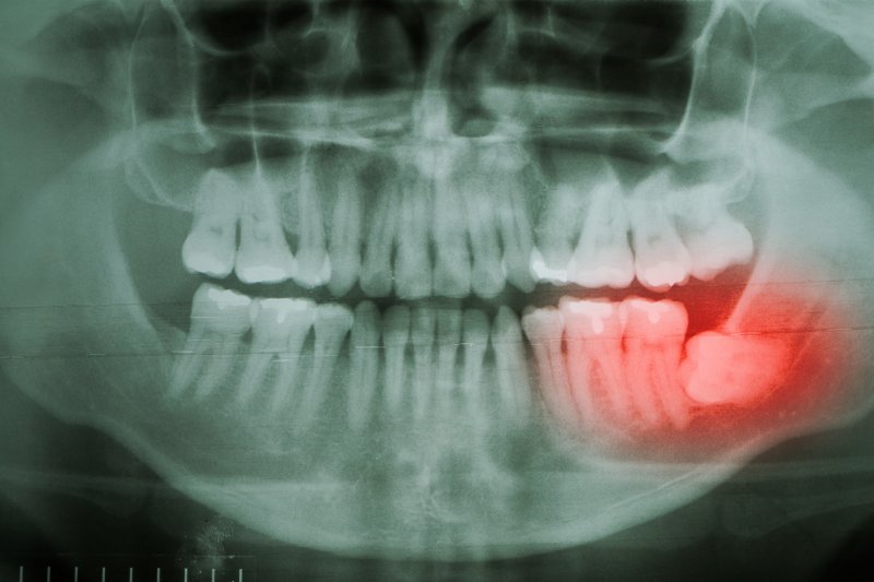 digital image of impacted wisdom tooth