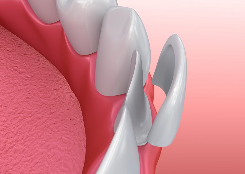 a digital image of a porcelain veneer going on over a tooth on the lower arch