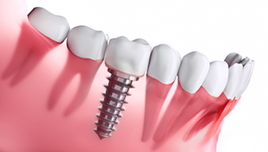 close-up dental implant animation