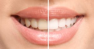 close-up of a beautiful smile before and after cosmetic dentistry