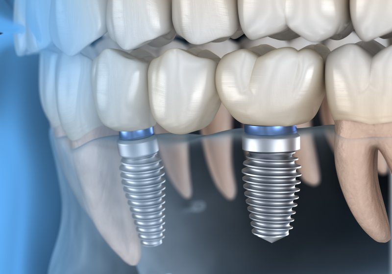 a digital image of a bottom row of teeth, complete with an implant bridge prosthetic