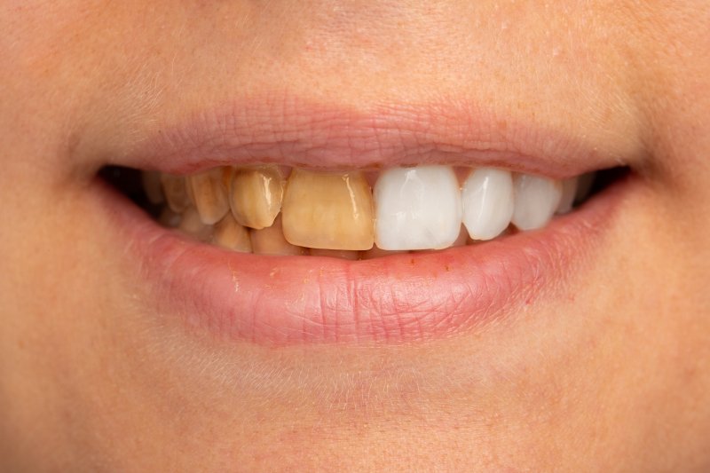 a close view of a person’s teeth with half appearing stained and the other half appearing white