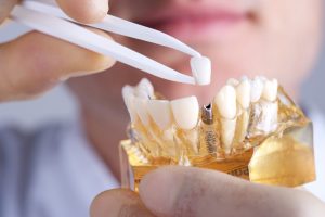 Your dentist in Castlerock performs in-office oral surgery