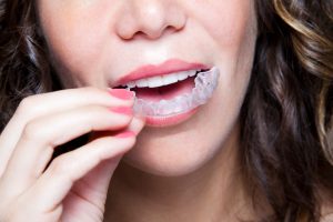 Your dentist for Invisalign in Castle Rock.