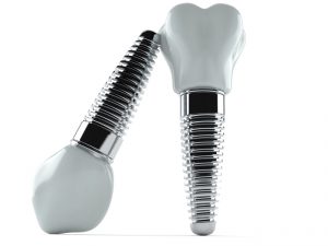 dental implant dentist near longview wa